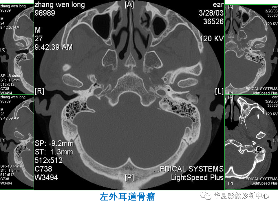 影像PPT - 【PPT】耳的影像解剖及常见疾病诊断-75