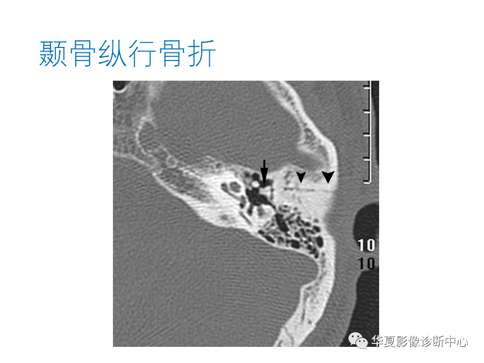 影像PPT - 【PPT】耳的影像解剖及常见疾病诊断-87