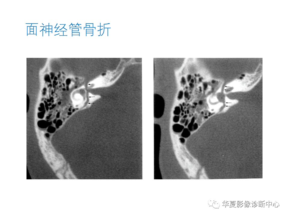 影像PPT - 【PPT】耳的影像解剖及常见疾病诊断-88