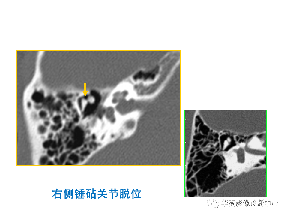 影像PPT - 【PPT】耳的影像解剖及常见疾病诊断-89