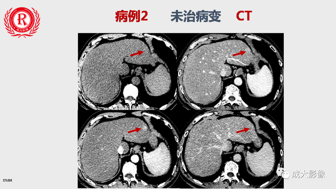 影像PPT - 【PPT】LI-RADS结构化报告实例应用-25