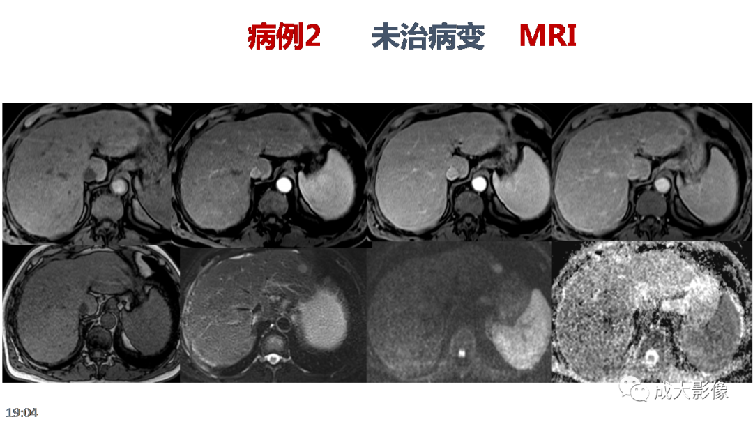 影像PPT - 【PPT】LI-RADS结构化报告实例应用-28