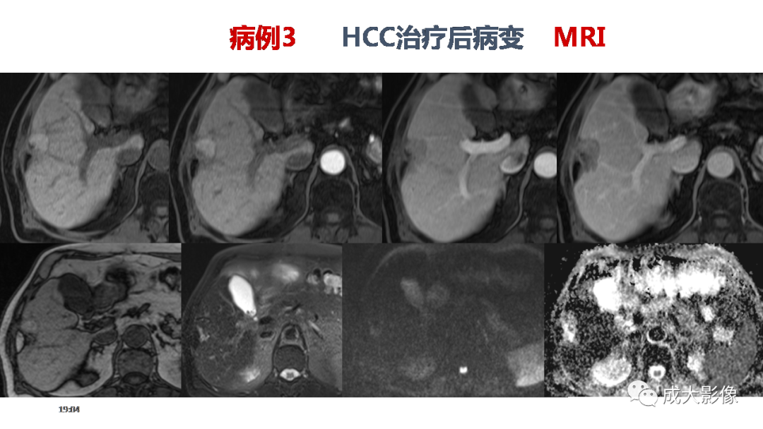 影像PPT - 【PPT】LI-RADS结构化报告实例应用-32