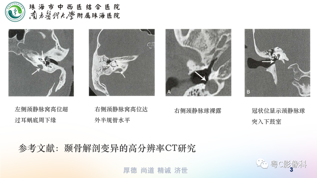 影像PPT - 【PPT】颞骨CT检查容易忽略的两个问题-3 影像PPT - 【PPT】颞骨CT检查容易忽略的两个问题-3