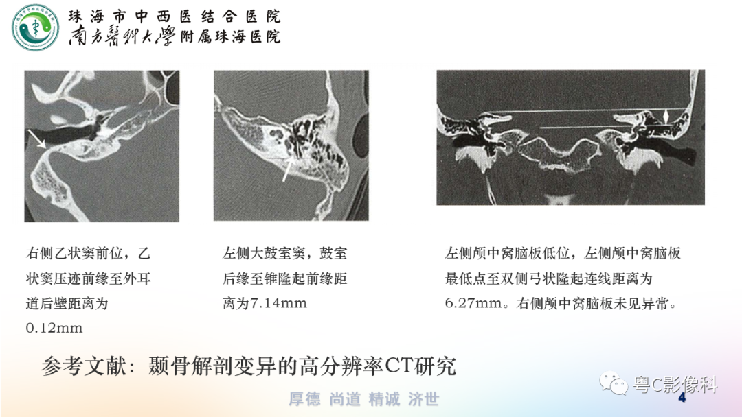 影像PPT - 【PPT】颞骨CT检查容易忽略的两个问题-4 影像PPT - 【PPT】颞骨CT检查容易忽略的两个问题-4