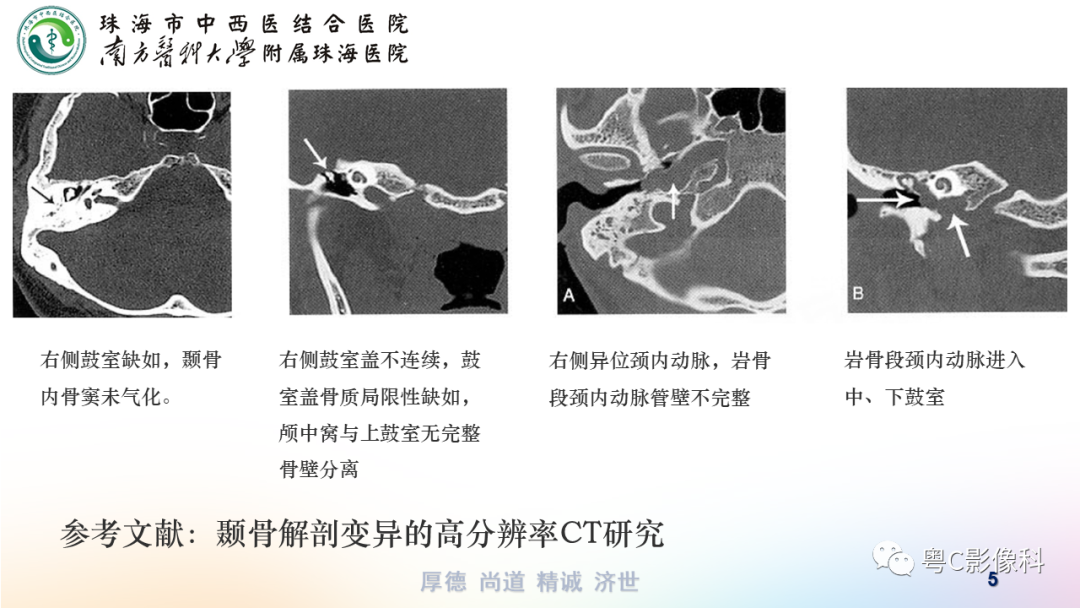 影像PPT - 【PPT】颞骨CT检查容易忽略的两个问题-5 影像PPT - 【PPT】颞骨CT检查容易忽略的两个问题-5