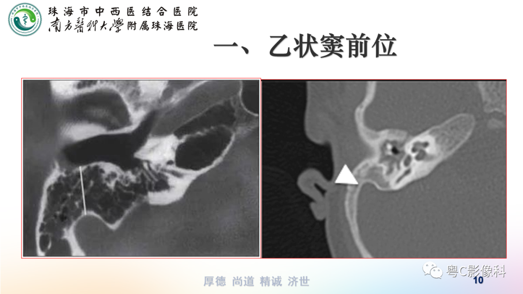 影像PPT - 【PPT】颞骨CT检查容易忽略的两个问题-10 影像PPT - 【PPT】颞骨CT检查容易忽略的两个问题-10