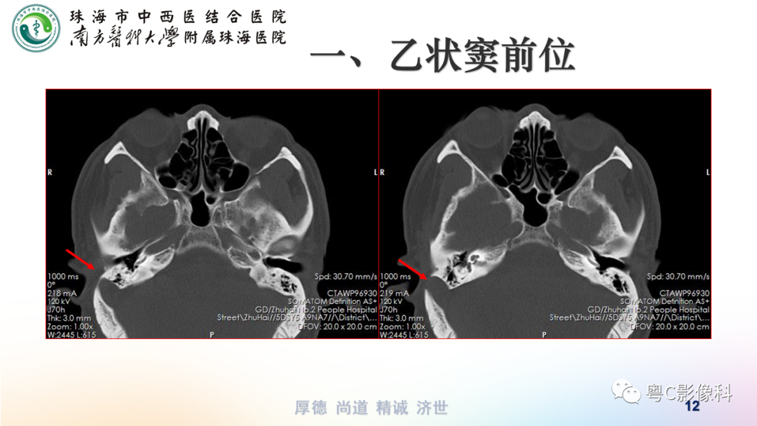 影像PPT - 【PPT】颞骨CT检查容易忽略的两个问题-12 影像PPT - 【PPT】颞骨CT检查容易忽略的两个问题-12