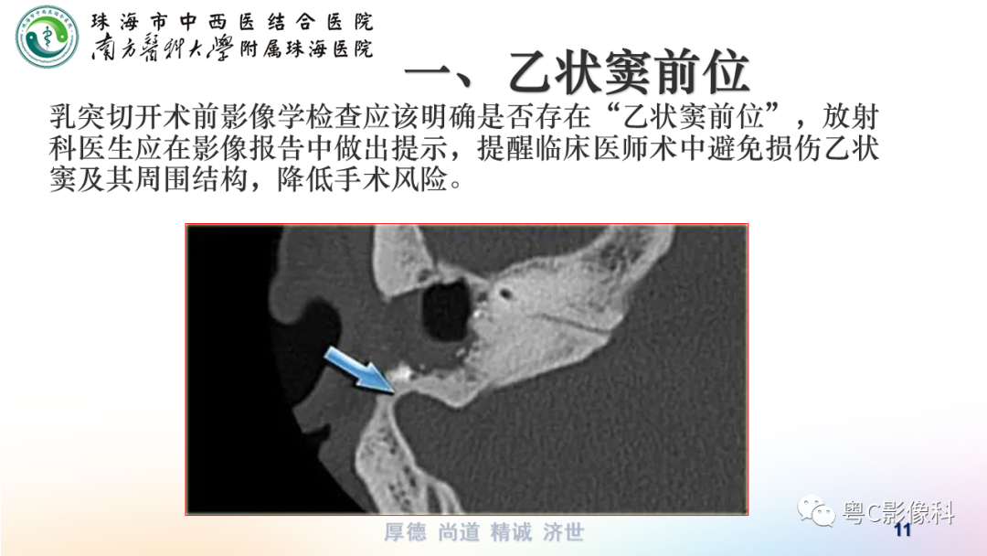 影像PPT - 【PPT】颞骨CT检查容易忽略的两个问题-11 影像PPT - 【PPT】颞骨CT检查容易忽略的两个问题-11