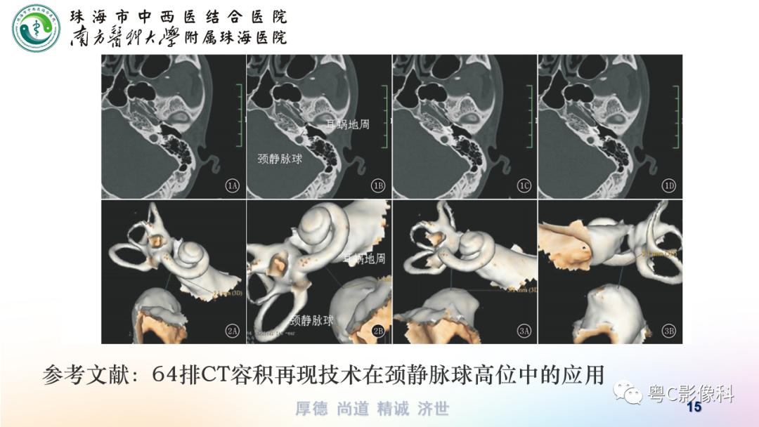 影像PPT - 【PPT】颞骨CT检查容易忽略的两个问题-15 影像PPT - 【PPT】颞骨CT检查容易忽略的两个问题-15