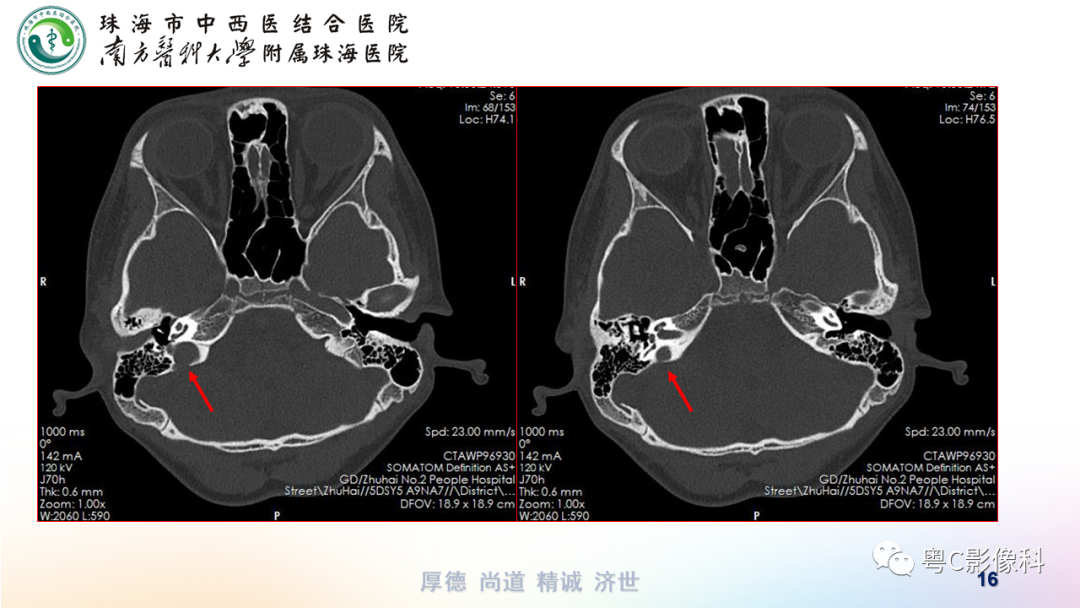影像PPT - 【PPT】颞骨CT检查容易忽略的两个问题-16 影像PPT - 【PPT】颞骨CT检查容易忽略的两个问题-16