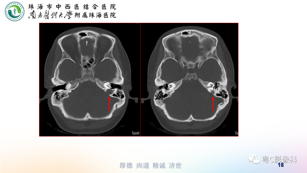 影像PPT - 【PPT】颞骨CT检查容易忽略的两个问题-18 影像PPT - 【PPT】颞骨CT检查容易忽略的两个问题-18