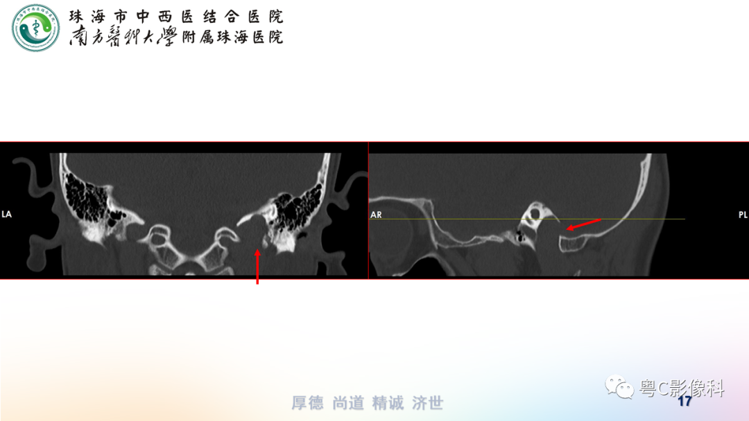 影像PPT - 【PPT】颞骨CT检查容易忽略的两个问题-17 影像PPT - 【PPT】颞骨CT检查容易忽略的两个问题-17