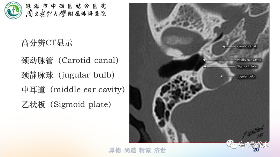 影像PPT - 【PPT】颞骨CT检查容易忽略的两个问题-20 影像PPT - 【PPT】颞骨CT检查容易忽略的两个问题-20