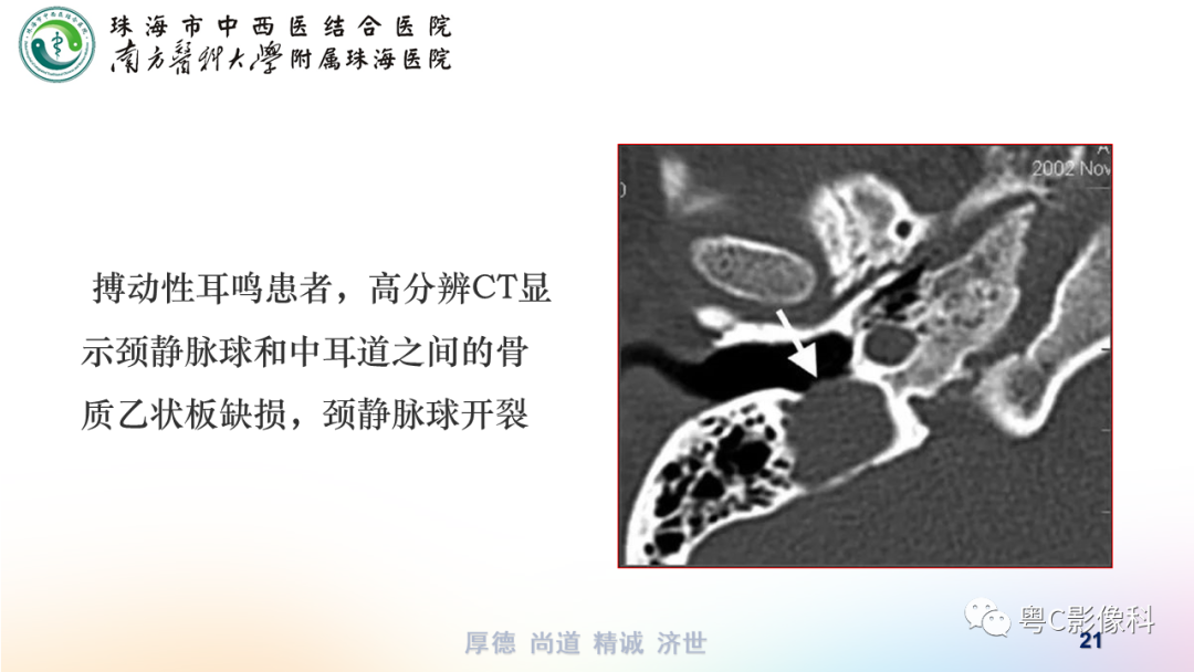 影像PPT - 【PPT】颞骨CT检查容易忽略的两个问题-21 影像PPT - 【PPT】颞骨CT检查容易忽略的两个问题-21
