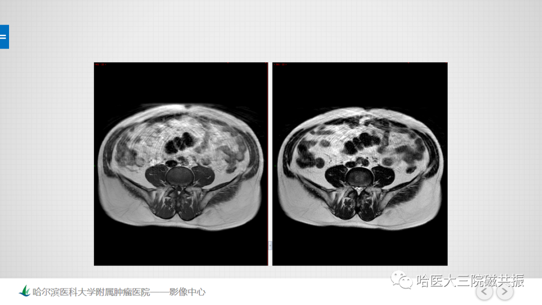 影像PPT - 【PPT】骨髓转化和再转化-2