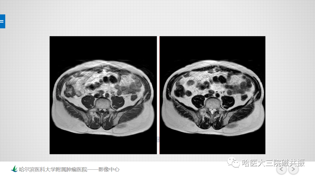 影像PPT - 【PPT】骨髓转化和再转化-3