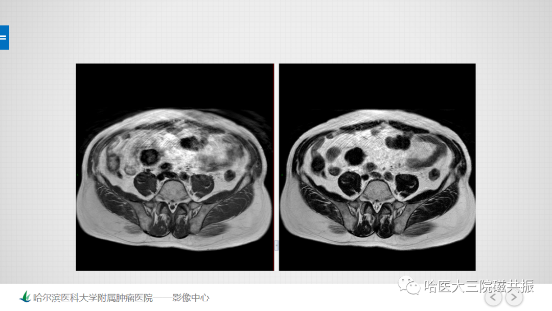 影像PPT - 【PPT】骨髓转化和再转化-4