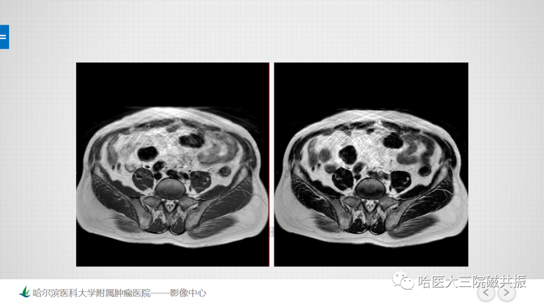 影像PPT - 【PPT】骨髓转化和再转化-5