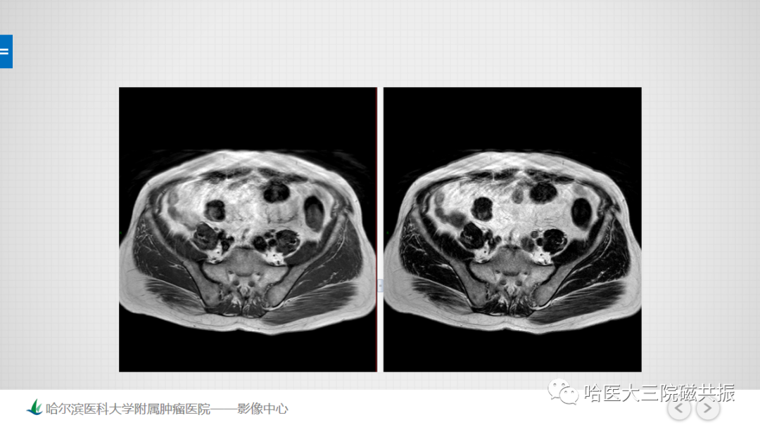 影像PPT - 【PPT】骨髓转化和再转化-6