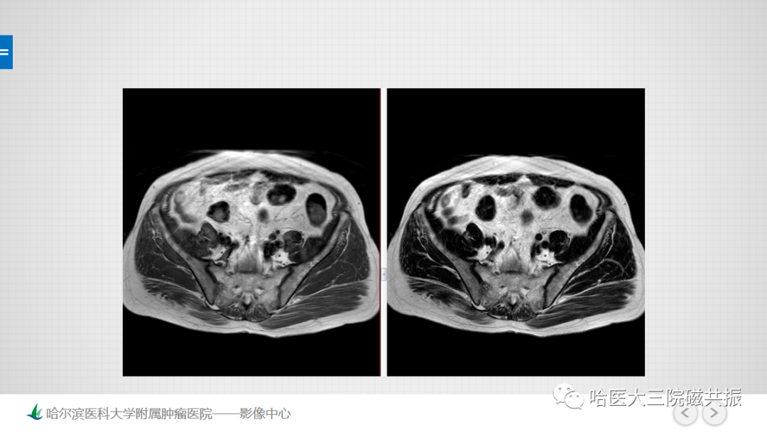 影像PPT - 【PPT】骨髓转化和再转化-7