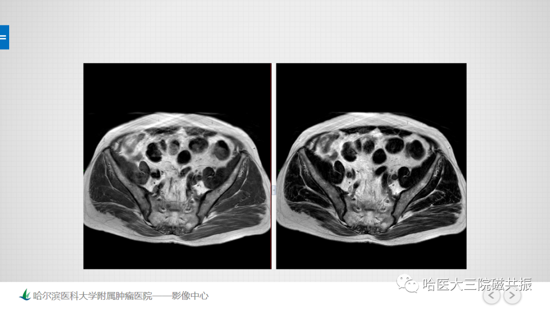 影像PPT - 【PPT】骨髓转化和再转化-8