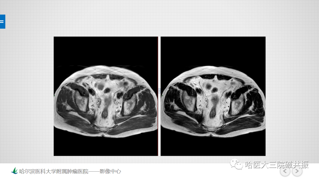 影像PPT - 【PPT】骨髓转化和再转化-11