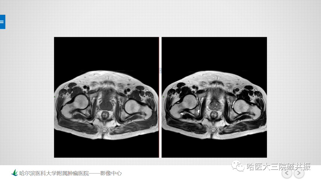 影像PPT - 【PPT】骨髓转化和再转化-13