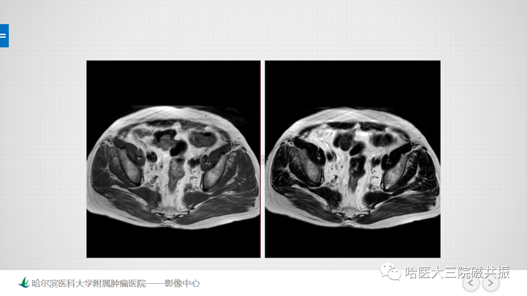 影像PPT - 【PPT】骨髓转化和再转化-10