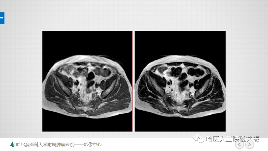 影像PPT - 【PPT】骨髓转化和再转化-9