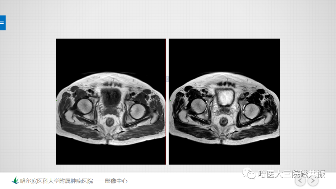 影像PPT - 【PPT】骨髓转化和再转化-12