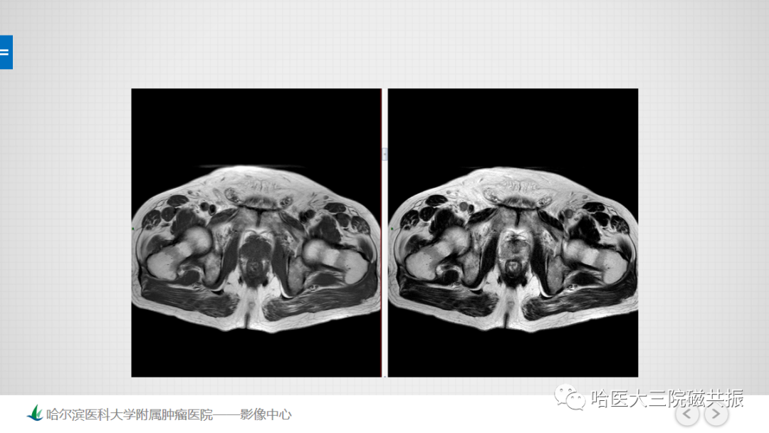 影像PPT - 【PPT】骨髓转化和再转化-14
