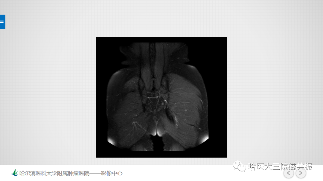 影像PPT - 【PPT】骨髓转化和再转化-15