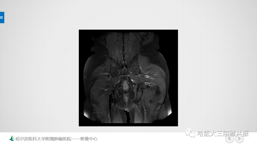 影像PPT - 【PPT】骨髓转化和再转化-16