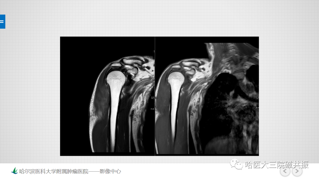影像PPT - 【PPT】骨髓转化和再转化-27