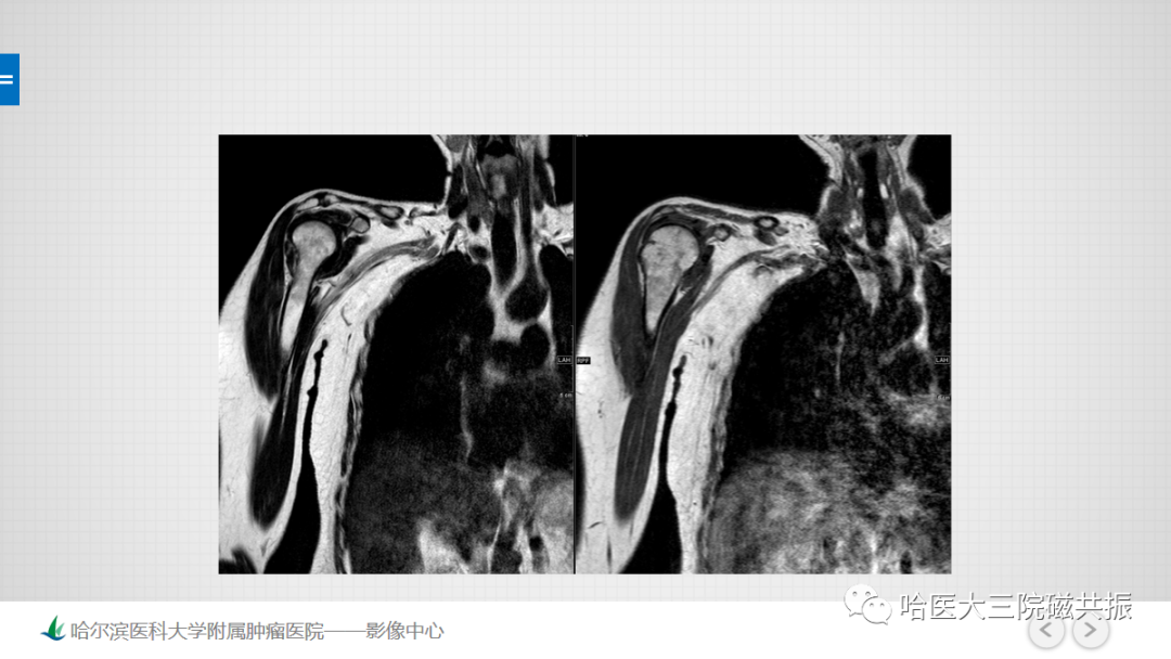 影像PPT - 【PPT】骨髓转化和再转化-28