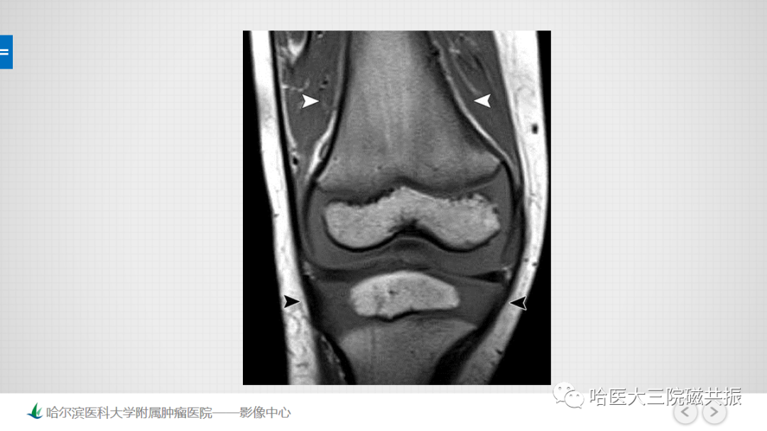 影像PPT - 【PPT】骨髓转化和再转化-30