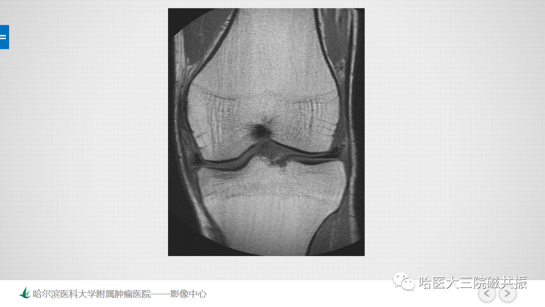 影像PPT - 【PPT】骨髓转化和再转化-32