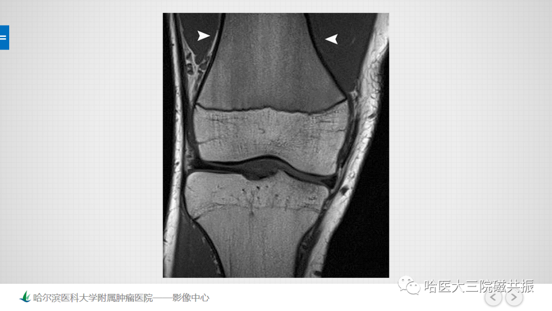 影像PPT - 【PPT】骨髓转化和再转化-31
