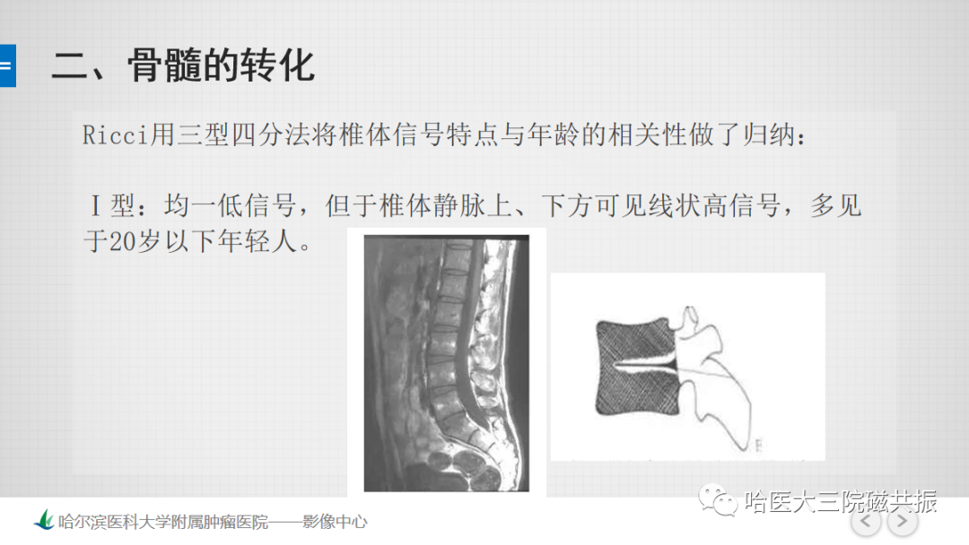 影像PPT - 【PPT】骨髓转化和再转化-34