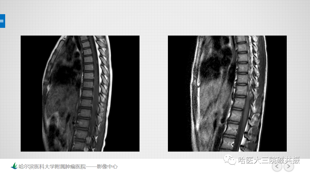影像PPT - 【PPT】骨髓转化和再转化-35