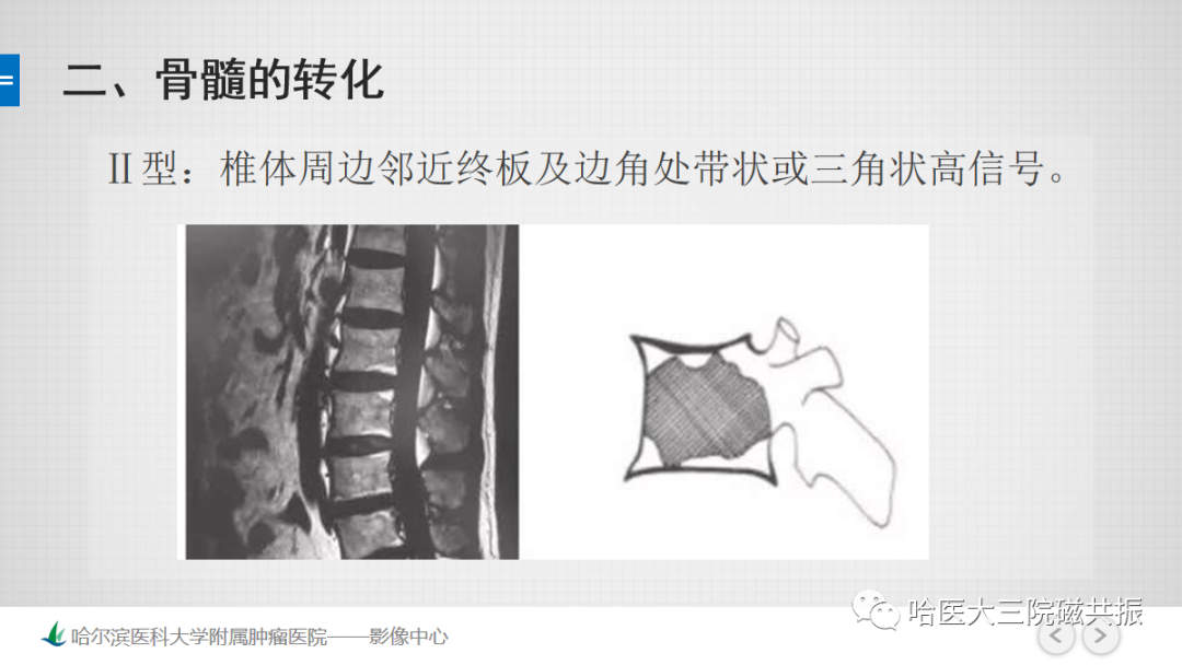 影像PPT - 【PPT】骨髓转化和再转化-36