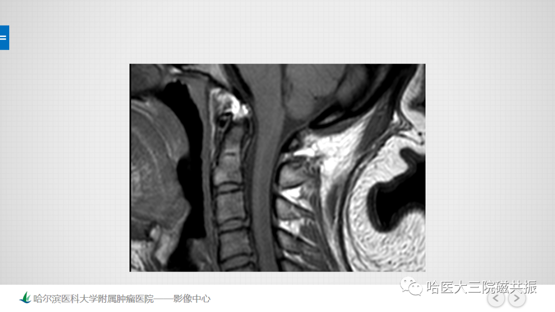 影像PPT - 【PPT】骨髓转化和再转化-37