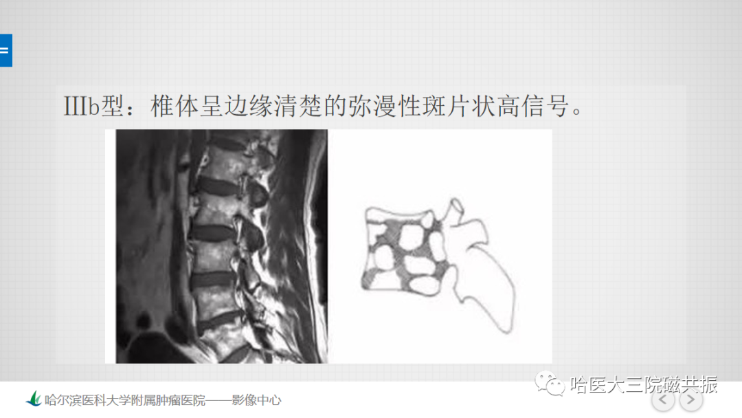 影像PPT - 【PPT】骨髓转化和再转化-40