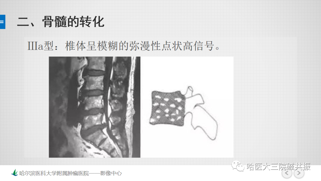 影像PPT - 【PPT】骨髓转化和再转化-38