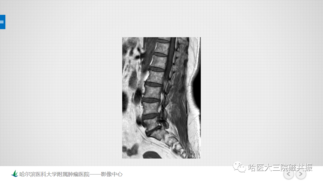 影像PPT - 【PPT】骨髓转化和再转化-39