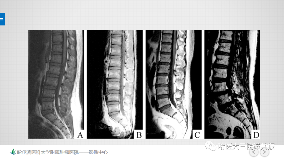 影像PPT - 【PPT】骨髓转化和再转化-41