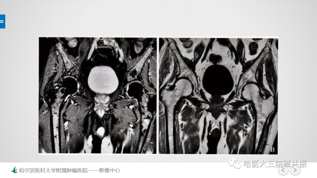 影像PPT - 【PPT】骨髓转化和再转化-49