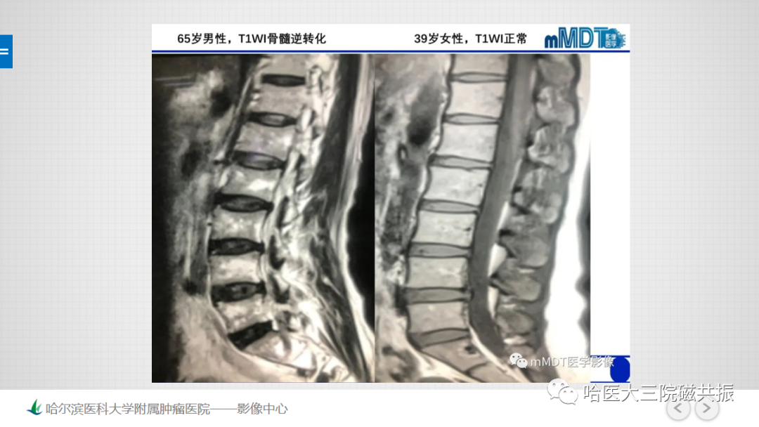 影像PPT - 【PPT】骨髓转化和再转化-50