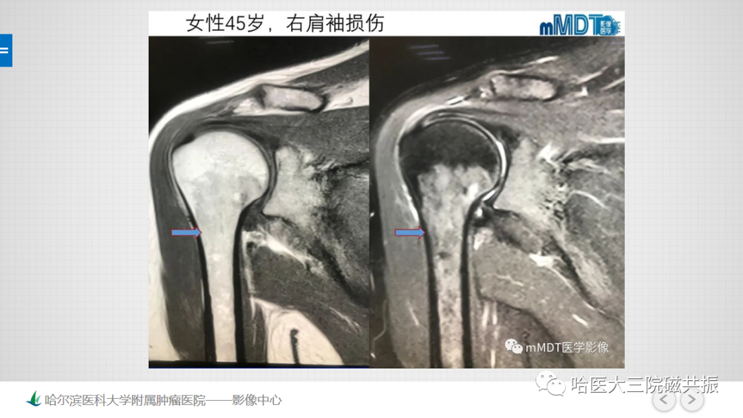 影像PPT - 【PPT】骨髓转化和再转化-51